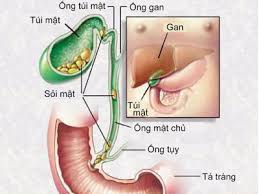 Bài thuốc chữa sỏi mật