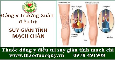 Thuốc Đông y điều trị suy giãn tĩnh mạch chân Thuốc Đông y điều trị suy giãn tĩnh mạch chân