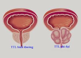 Thực phẩm giúp ngừa ung thư tuyến tiền liệt